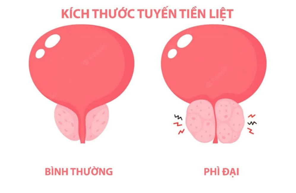 Phì đại tuyến tiền liệt: Nguyên nhân, dấu hiệu và cách điều trị