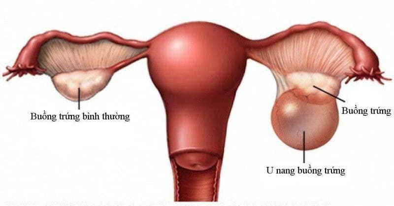 U bì buồng trứng: Nguyên nhân, dấu hiệu và cách điều trị