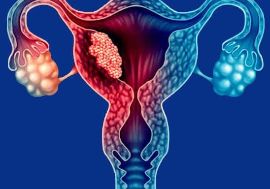 Ung thư âm hộ: Nguyên nhân, dấu hiệu và cách xử trí