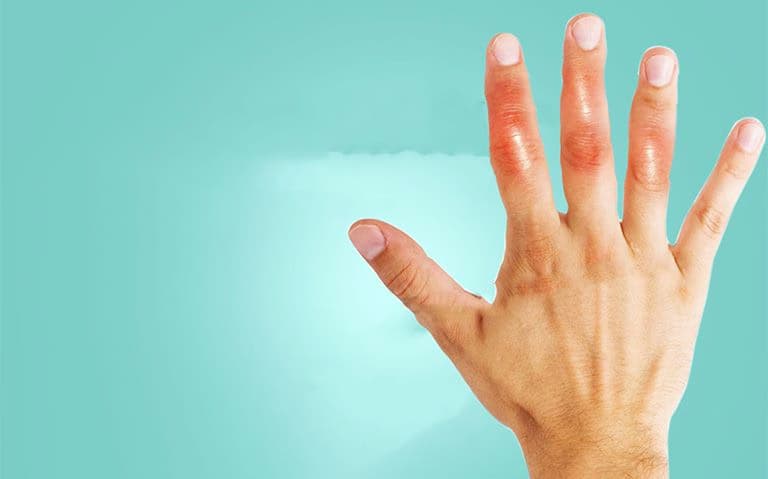 Viêm khớp tay: Nguyên nhân, dấu hiệu và cách điều trị