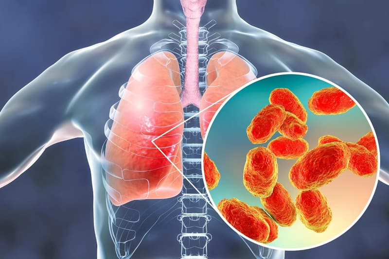 Nhiễm nấm Histoplasma: Nguyên nhân, dấu hiệu và cách điều trị
