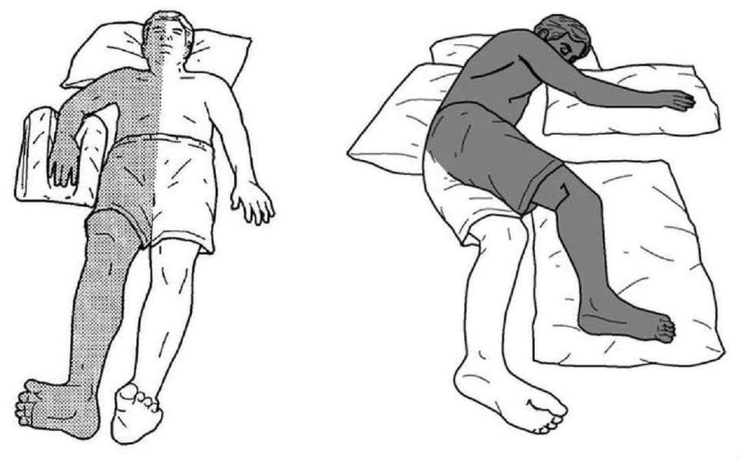Liệt nửa người: Nguyên nhân, dấu hiệu và cách phục hồi