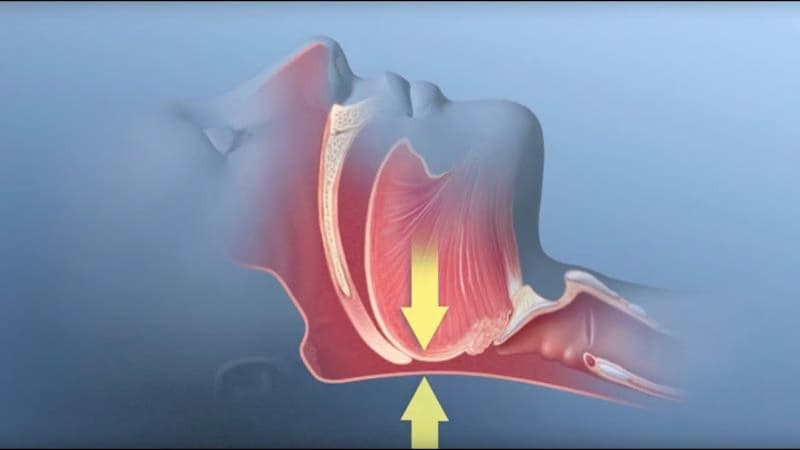 Ngưng thở khi ngủ do tắc nghẽn: Dấu hiệu, nguyên nhân và cách can thiệp