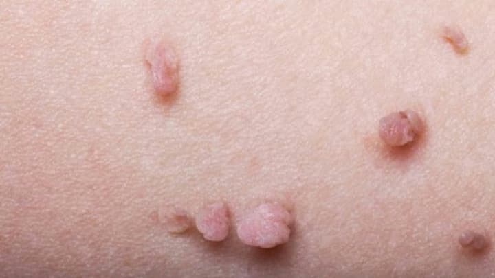 Mụn cóc sinh dục: Nguyên nhân, dấu hiệu và cách điều trị