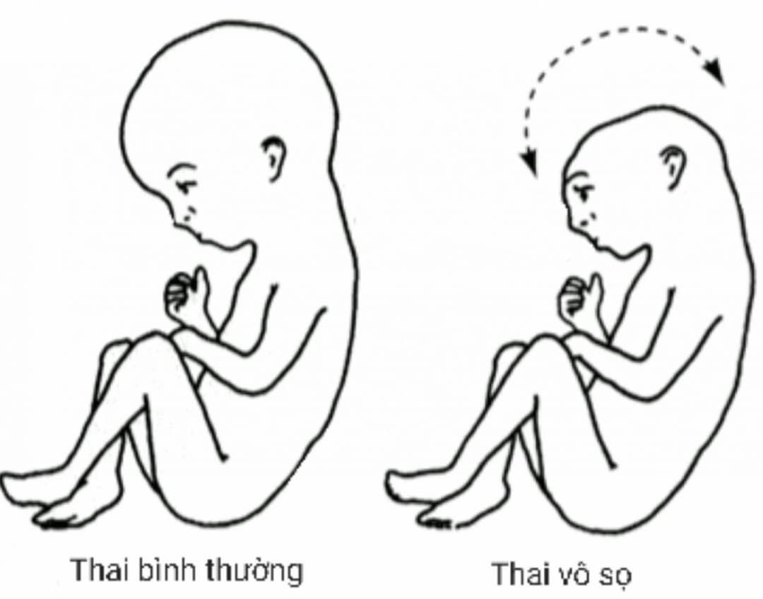 Thiếu một phần não ở thai nhi: Dấu hiệu, nguyên nhân và biện pháp phòng ngừa