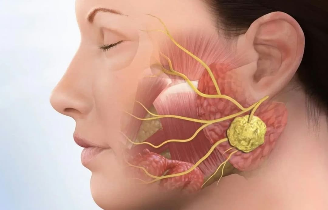 Ung thư tuyến nước bọt: Nguyên nhân, dấu hiệu và cách điều trị