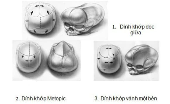 Chứng dính liền khớp sọ sớm ở trẻ em: Nguyên nhân, dấu hiệu và phương pháp chẩn đoán