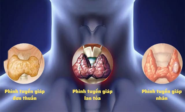 Bướu giáp đơn thuần: Nguyên nhân, dấu hiệu và cách điều trị