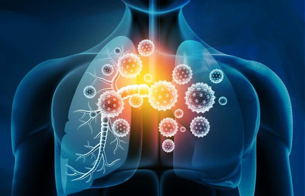 Viêm phổi do virus: Nguyên nhân, triệu chứng, chẩn đoán và cách xử trí
