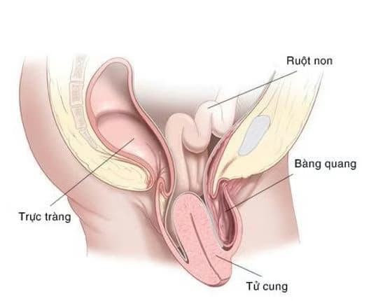 Sa tử cung: Nguyên nhân, dấu hiệu và cách điều trị