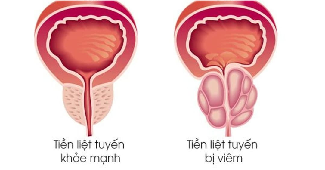 Viêm tuyến tiền liệt mạn tính: Nguyên nhân, triệu chứng và cách điều trị