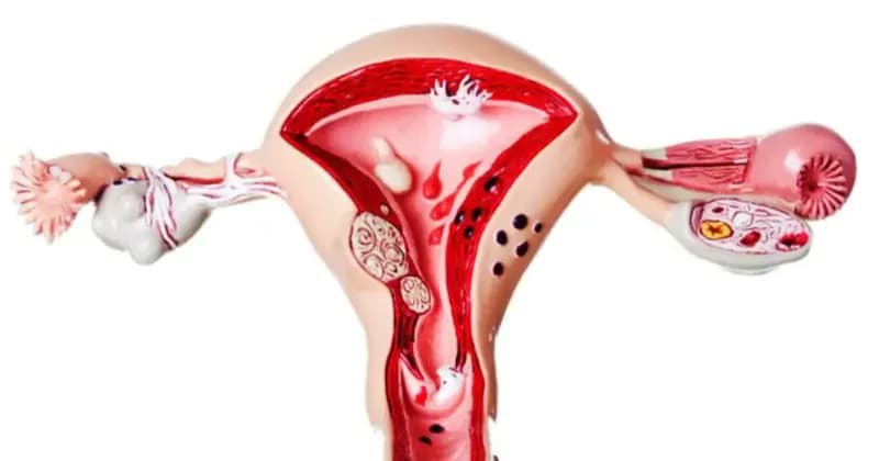 Xuất huyết tử cung bất thường: Nguyên nhân, dấu hiệu và cách điều trị