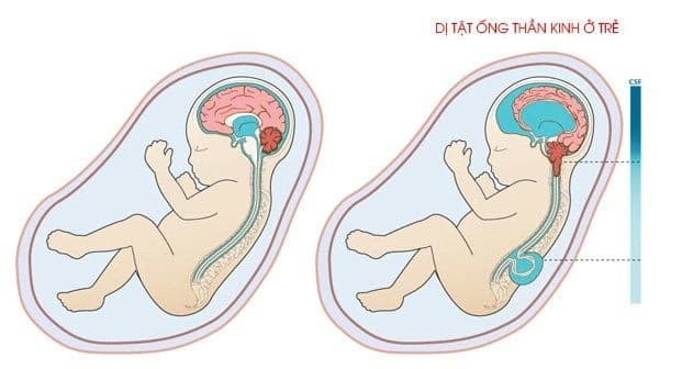 Dị tật ống thần kinh ở thai nhi: Nguyên nhân, dấu hiệu và cách phòng ngừa