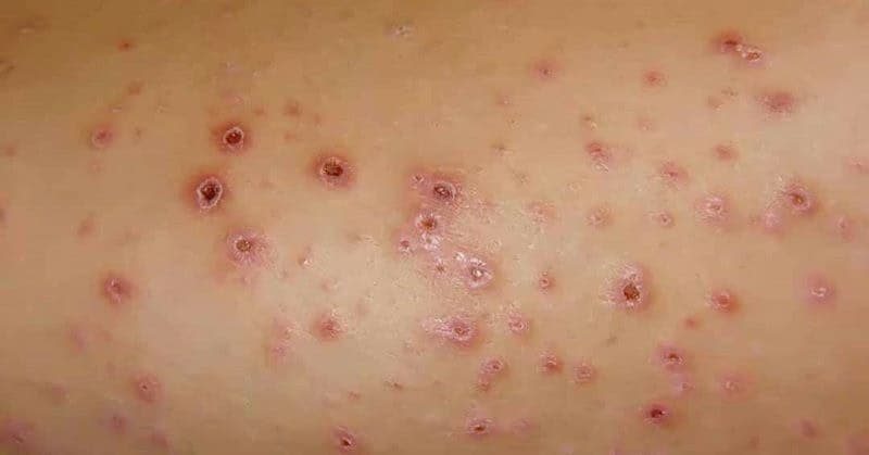 Bệnh lichen phẳng: Nguyên nhân, triệu chứng và cách điều trị