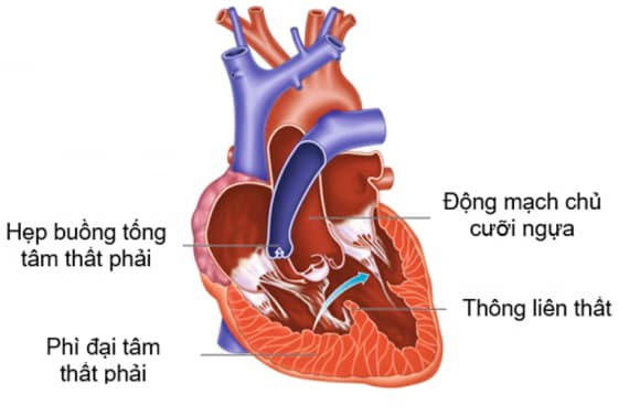 Tứ chứng Fallot: Nguyên nhân, dấu hiệu, chẩn đoán và điều trị