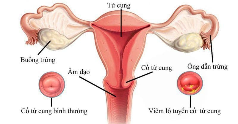 Viêm lộ tuyến cổ tử cung: Nguyên nhân, triệu chứng và cách điều trị