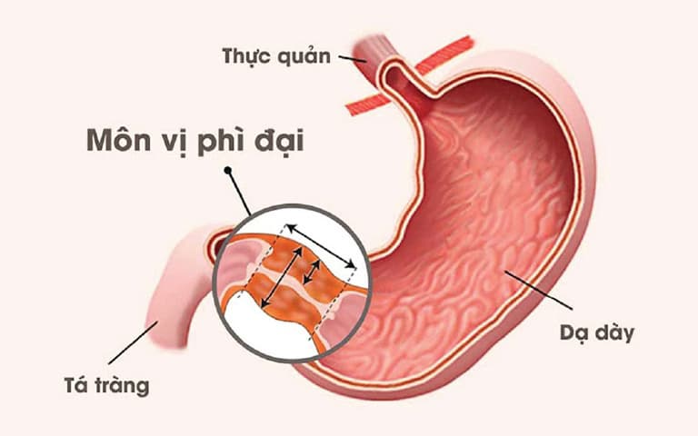 Hẹp môn vị phì đại: Nguyên nhân, dấu hiệu và cách điều trị