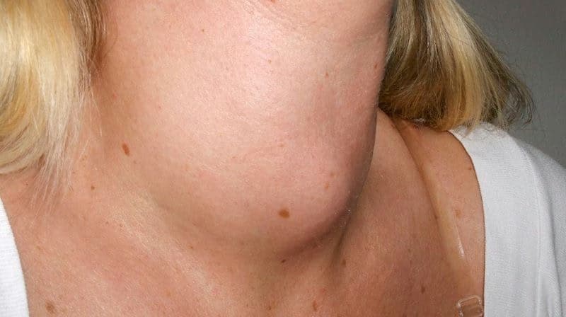 Bướu cổ: Tổng quan bệnh học, nguyên nhân, triệu chứng và quy trình chẩn đoán