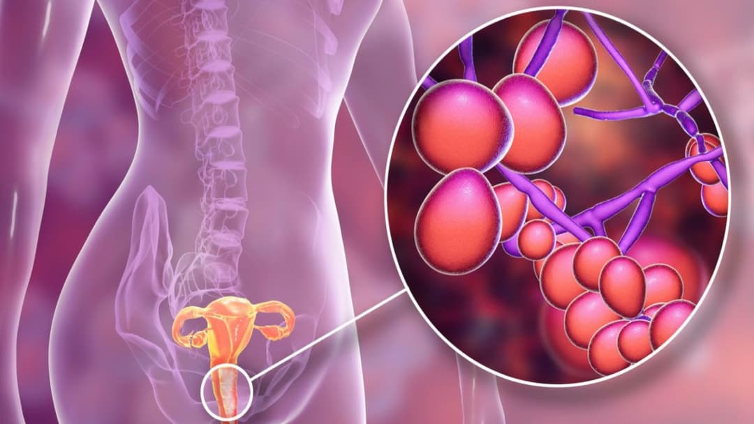Nhiễm nấm Candida: Nguyên nhân, triệu chứng và cách điều trị