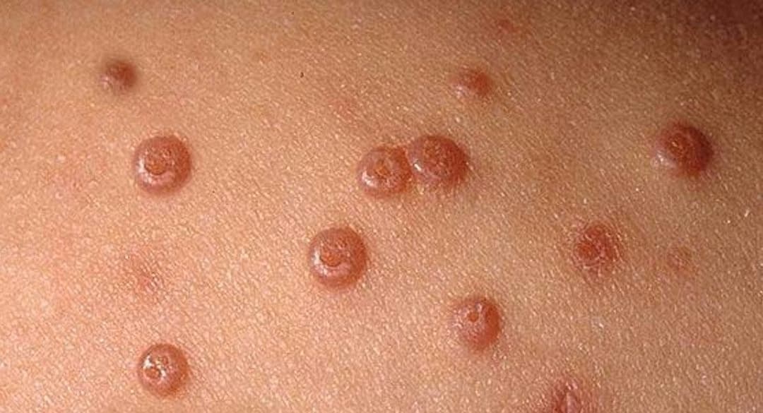 Bệnh u mềm lây: Nguyên nhân, dấu hiệu và cách xử trí