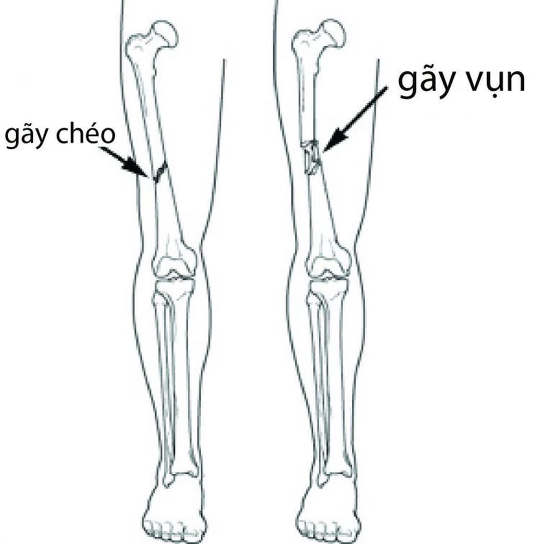 Gãy xương: Nguyên nhân, dấu hiệu, biến chứng và cách điều trị