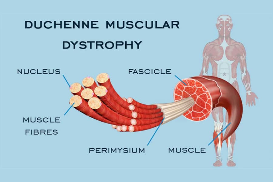 Loạn dưỡng cơ Duchenne: Dấu hiệu, nguyên nhân và cách chăm sóc