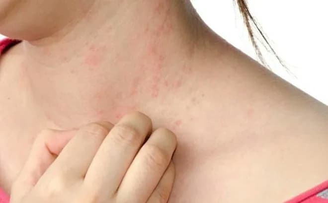 Viêm da dị ứng: Dấu hiệu, nguyên nhân và nguyên tắc chăm sóc