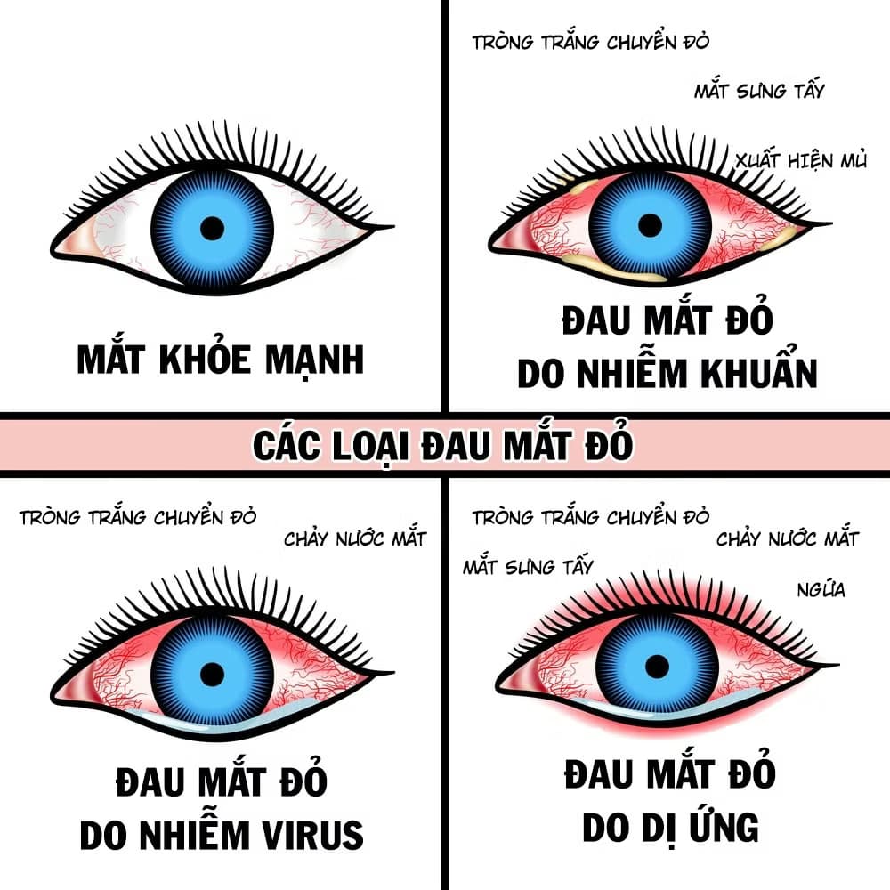 Bệnh đau mắt đỏ (Viêm kết mạc)