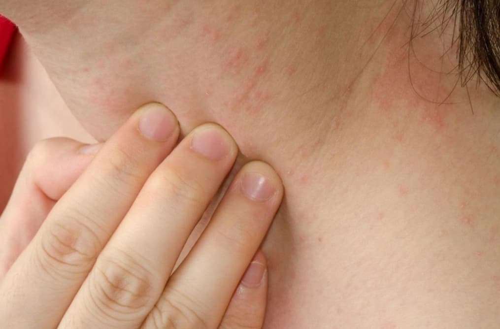 Ngứa da là gì? Nguyên nhân, dấu hiệu và cách xử trí