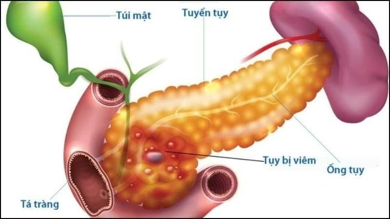 Viêm tụy mạn tính tái phát: Nguyên nhân, dấu hiệu và cách xử trí