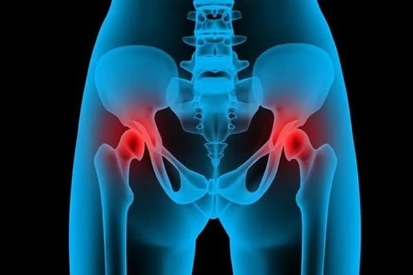 Viêm khớp háng: Nguyên nhân, triệu chứng và các cách điều trị