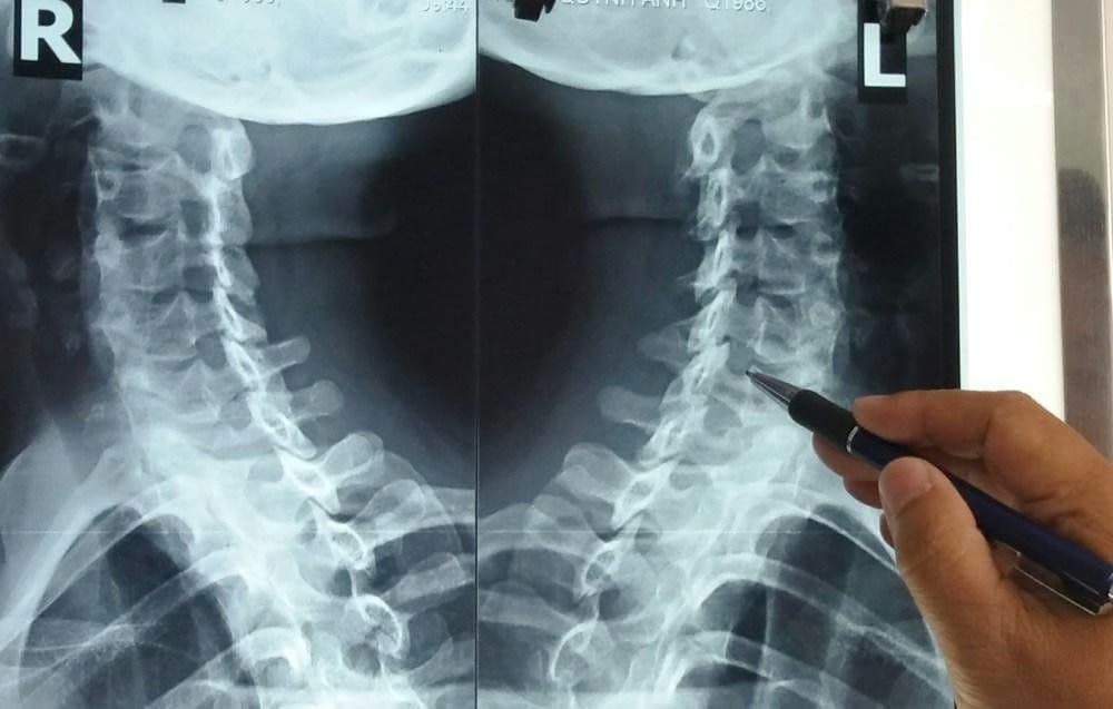 Hẹp lỗ liên hợp đốt sống cổ: Nguyên nhân, dấu hiệu và cách điều trị