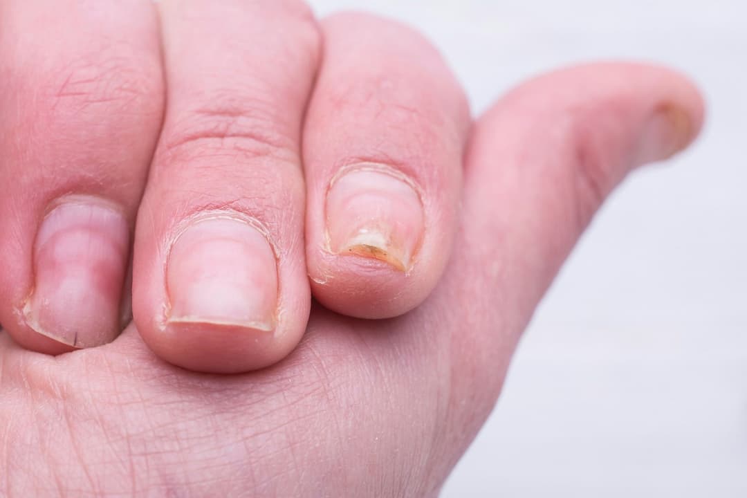 Loạn dưỡng móng: Nguyên nhân, triệu chứng và cách chăm sóc