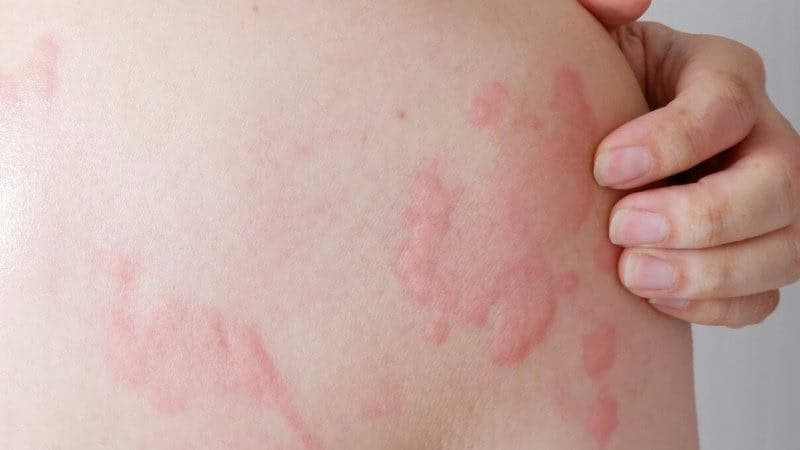 Bệnh mề đay: Nguyên nhân, dấu hiệu và cách điều trị