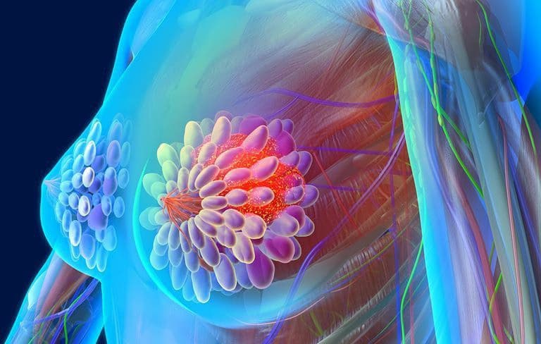 Ung thư vú: Nguyên nhân, dấu hiệu và cách điều trị