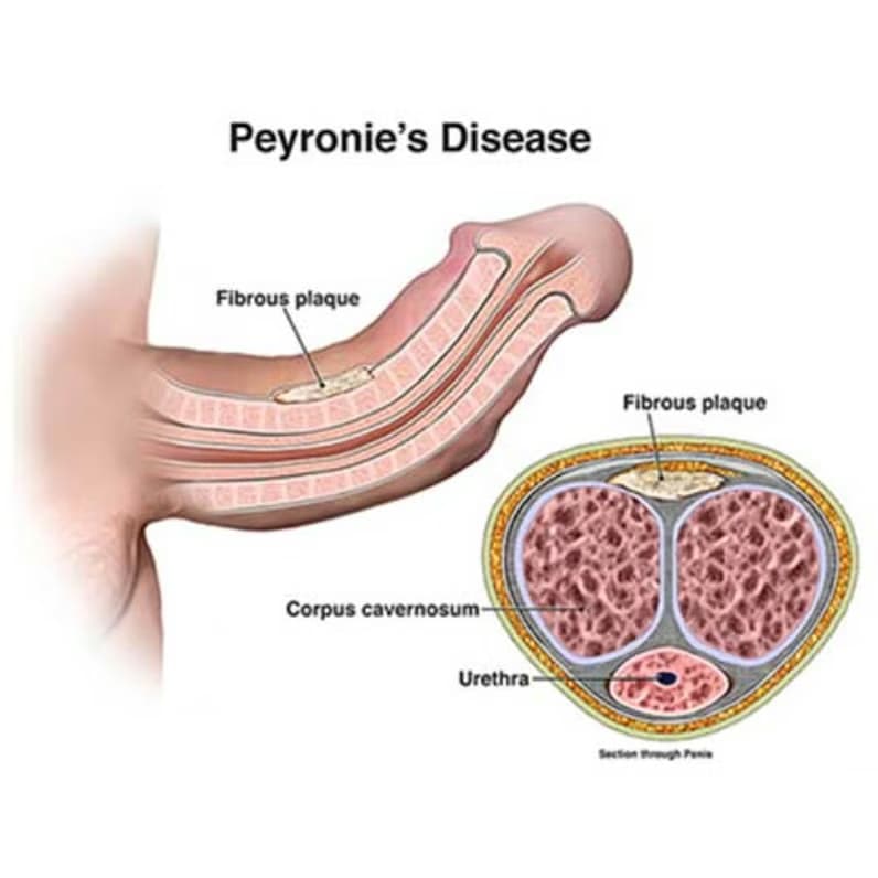 Bệnh Peyronie (xơ cứng vật hang): Nguyên nhân, dấu hiệu và cách xử trí