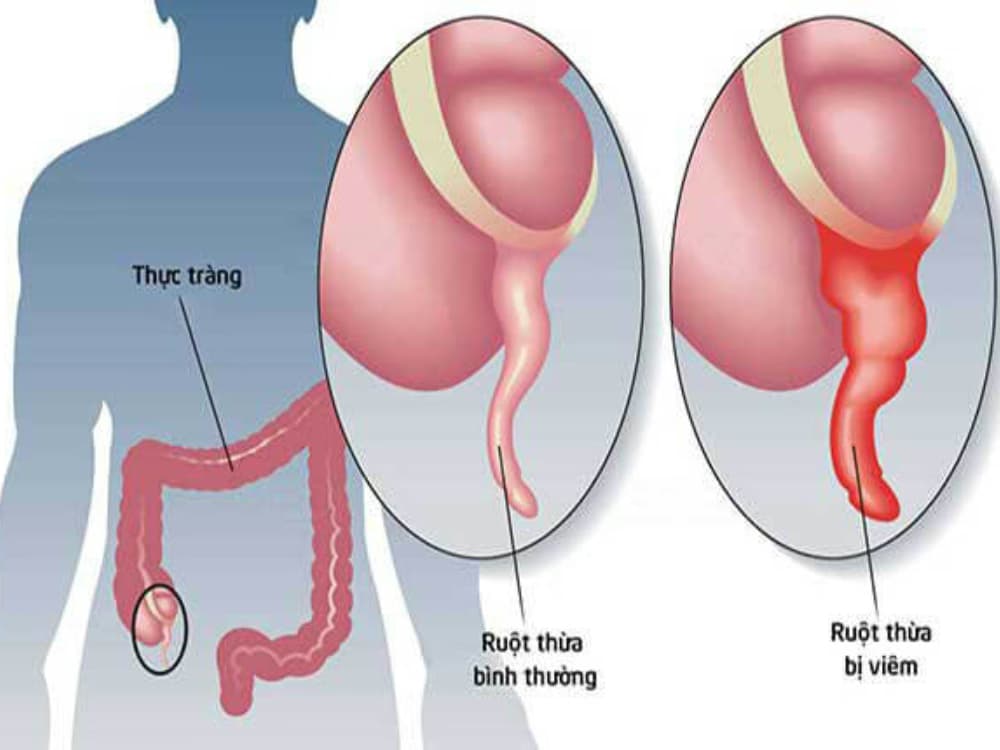 Viêm ruột thừa: Nguyên nhân, dấu hiệu và cách điều trị