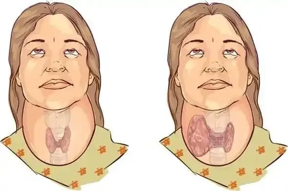 Bướu giáp nhân thùy phải: Nguyên nhân, dấu hiệu và phương pháp chẩn đoán