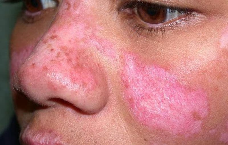 Lupus ban đỏ dạng đĩa: Nguyên nhân, triệu chứng và cách kiểm soát