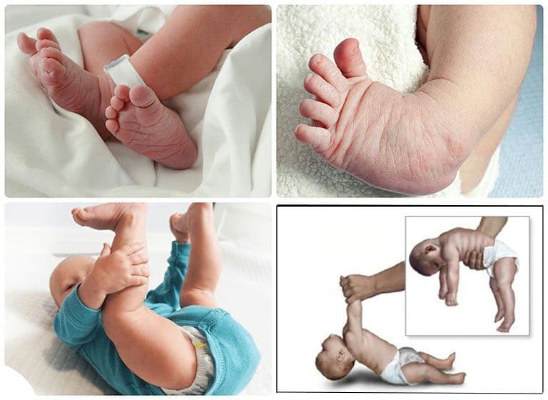 Cứng đa khớp bẩm sinh: Nguyên nhân, dấu hiệu và cách quản lý chức năng