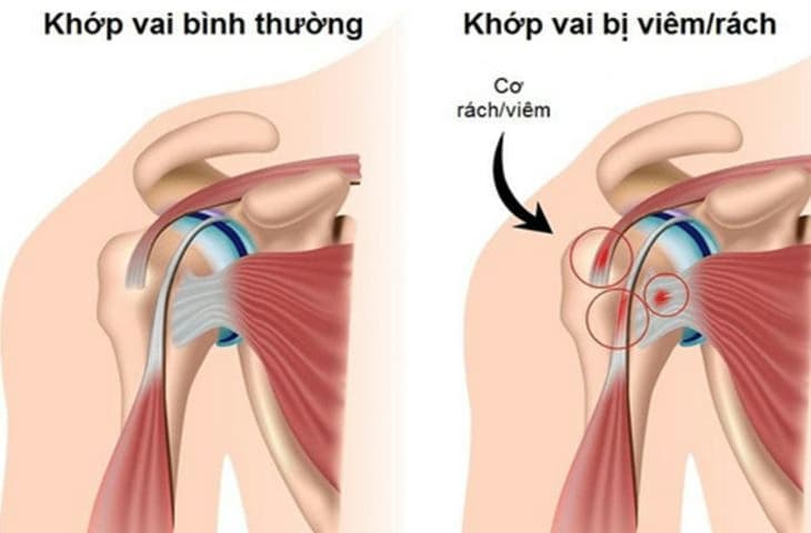 Viêm khớp vai: Nguyên nhân, dấu hiệu và cách điều trị