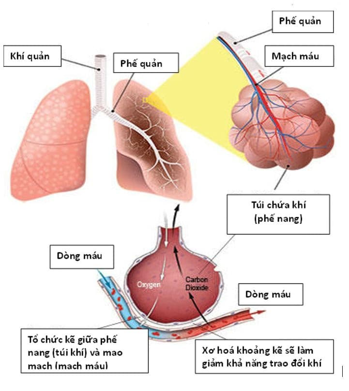 Bệnh phổi kẽ: Nguyên nhân, dấu hiệu và cách điều trị