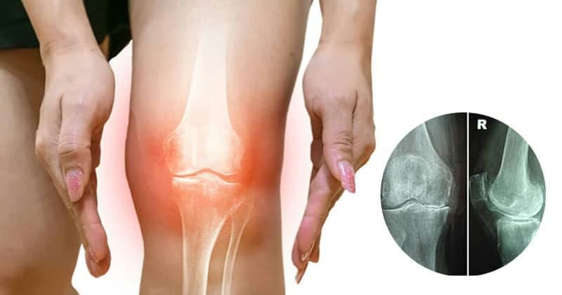 Hẹp khe khớp gối: Nguyên nhân, dấu hiệu và cách điều trị