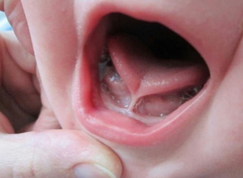 Dính thắng lưỡi: Nguyên nhân, dấu hiệu và cách điều trị