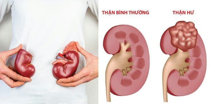 Hội chứng thận hư: Nguyên nhân, dấu hiệu và cách điều trị