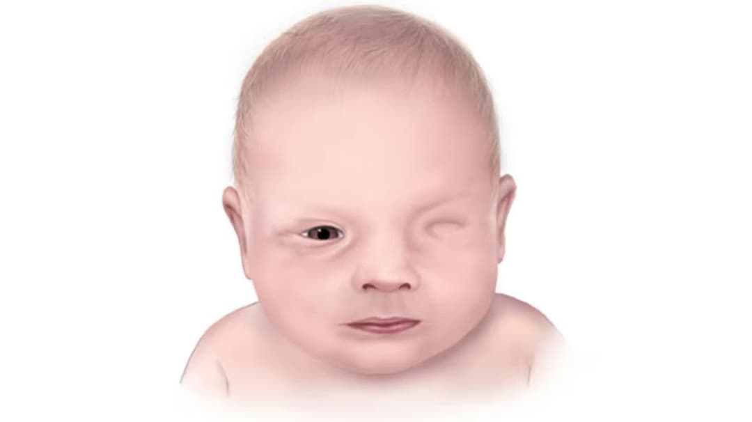 Tật không nhãn cầu: Nguyên nhân, dấu hiệu và can thiệp