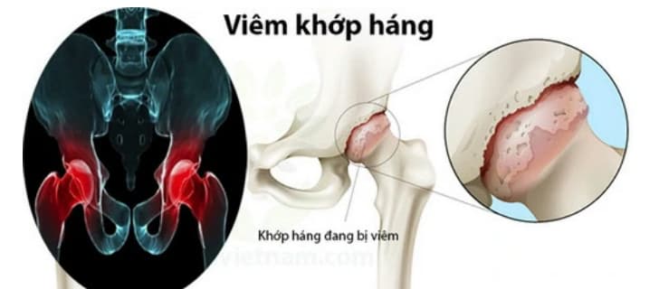 Viêm khớp háng ở trẻ em: Nguyên nhân, dấu hiệu và cách điều trị