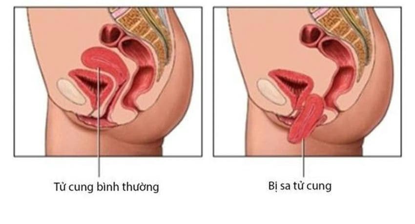 Sa sinh dục ở nữ giới: Nguyên nhân, dấu hiệu và các cách điều trị