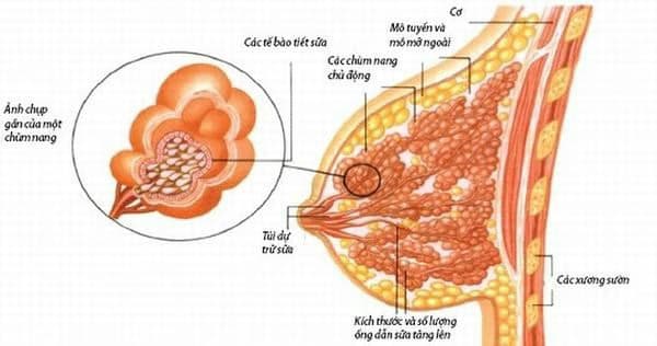 Bướu sợi tuyến vú: Dấu hiệu, nguyên nhân và quy trình chẩn đoán