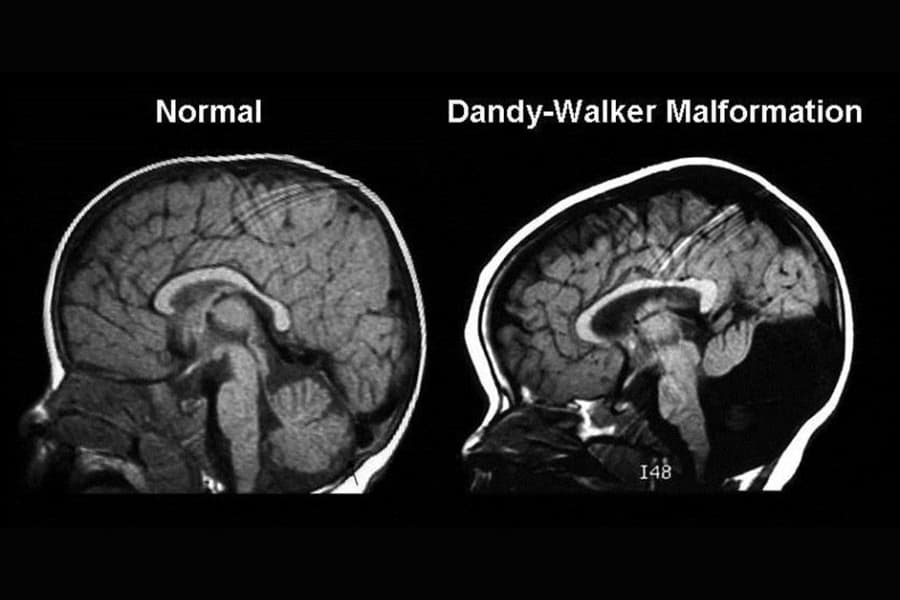 Dị tật Dandy-Walker: Nguyên nhân, dấu hiệu và cách điều trị